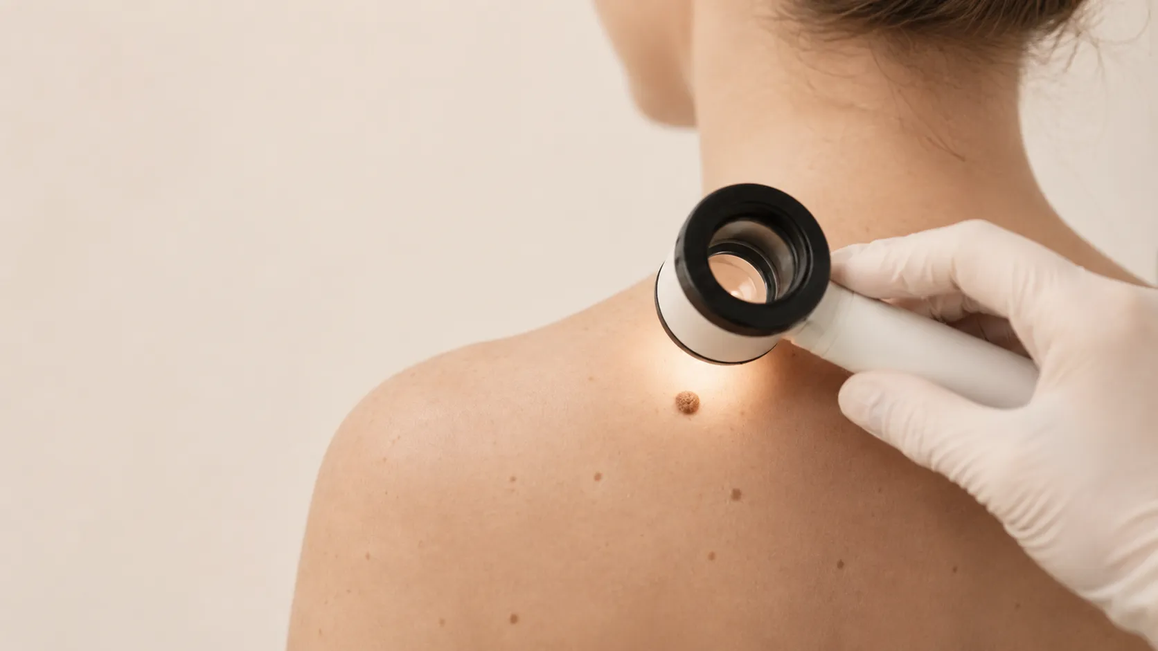 Dermatoskopski pregled kožnih znamenj